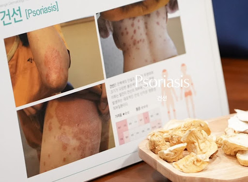 생기한의원 건선 관련 홍피성 건선 증상 기본 정보
